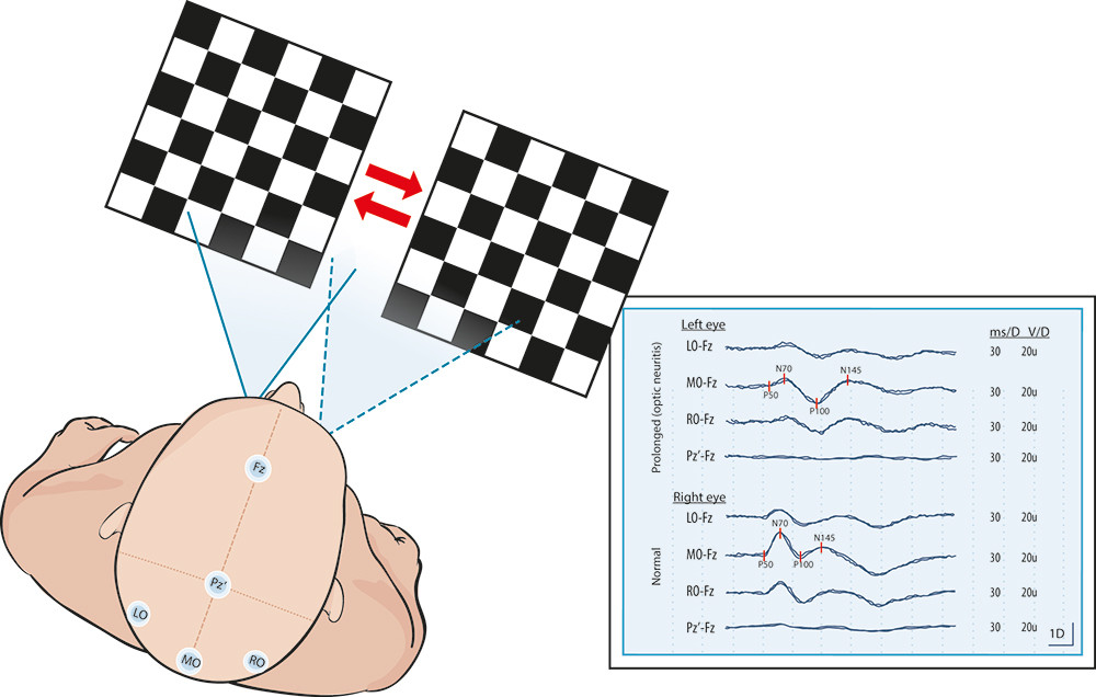 Figure 3  Study of visually evoked potentials (VEP) where the visual pathways are examined by stimulating each eye with an&hellip;