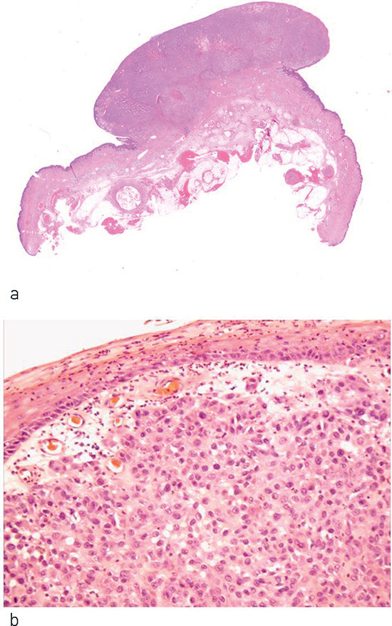 Figure 1  a) Polypoid malignant melanoma of nodular subtype, b) Diffuse (undifferentiated) growth of strongly atypical cells&hellip;