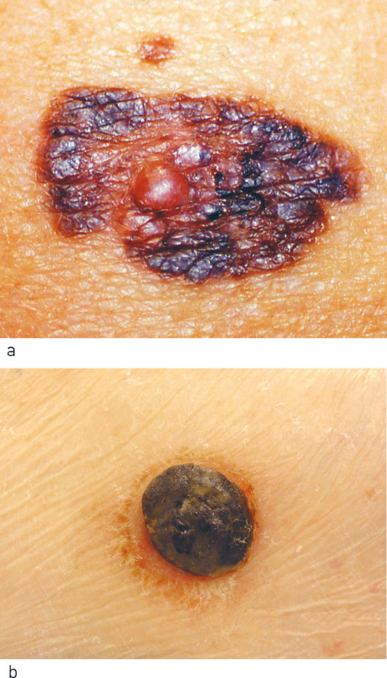 Figure 2  Main types of cutaneous primary malignant melanoma: a) Superficial spreading malignant melanoma and b) nodular&hellip;
