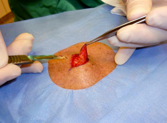 Figure 3  Surgery for primary malignant melanoma of the skin. Photo Henrik L. Svendsen