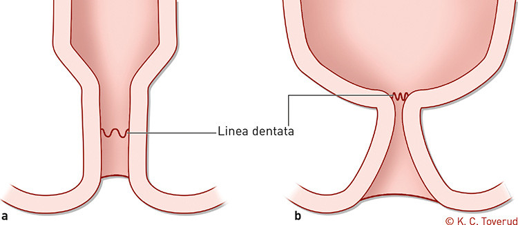 Figure 2  a) Normal anal canal. b) Funnel-shaped anal canal with stenosis at the level of the dentate line &ndash; a&hellip;
