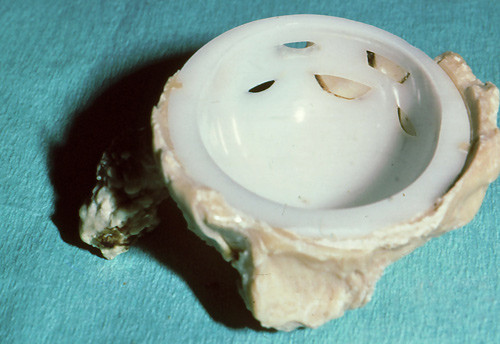 Figure 5  A Christiansen prosthesis revised at the Coastal Hospital in Hagevik. The Delrin cup has been worn right through&hellip;