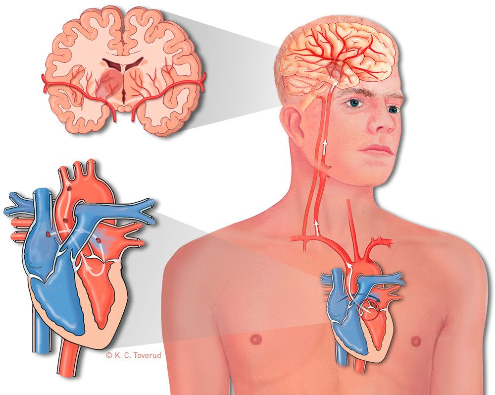 Figure 2  An embolus passes through a patent foramen ovale from the right to the left atrium and embolises to the brain,&hellip;