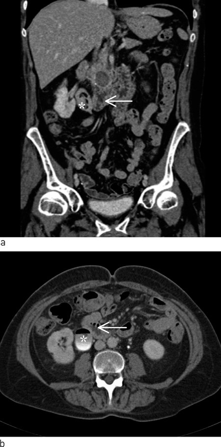 Figure 1  CT urinary tract with intravenous contrast in secretion phase. Coronal (a) and axial (b) reconstruction show close&hellip;