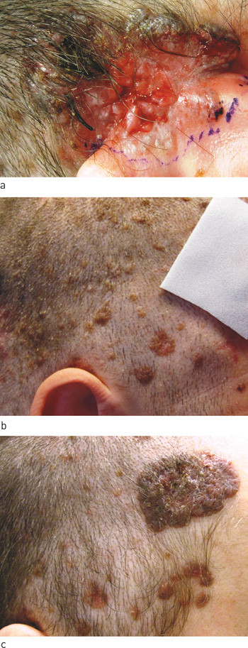 Figure 1  The patient at first visit to the dermatologist. a) Weeping sore in a basal cell carcinoma behind the ear. b)&hellip;