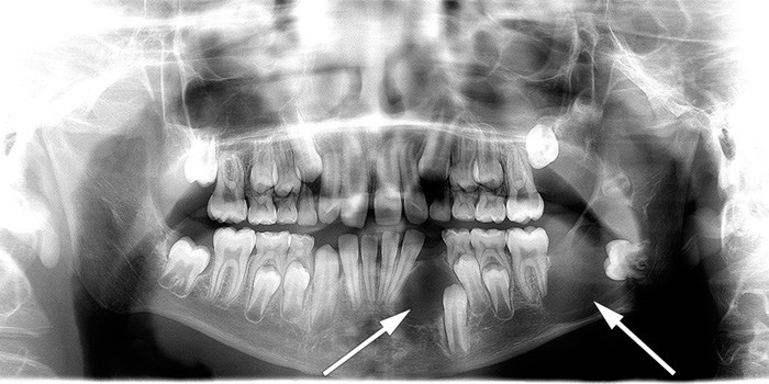 Figure 2  Illustrative image showing jaw cysts. Orthopantomography (OPG) of a boy diagnosed with Gorlin syndrome. In the&hellip;