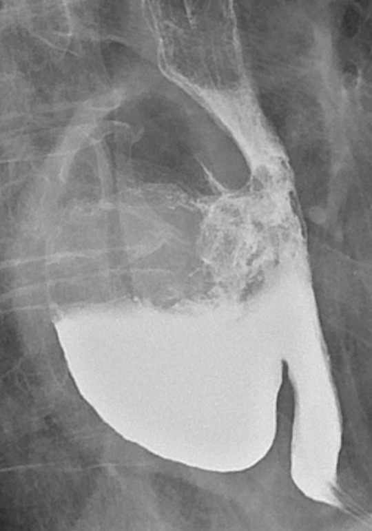 Figure 1  Large, partly contrast-filled epiphrenic oesophageal diverticulum facing towards the right in the mediastinum