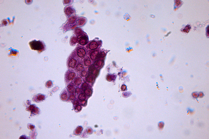 Figure 3  Urine sediment enlarged 40 times shows abundant tubular epithelial cells. Such a finding is of great diagnostic&hellip;