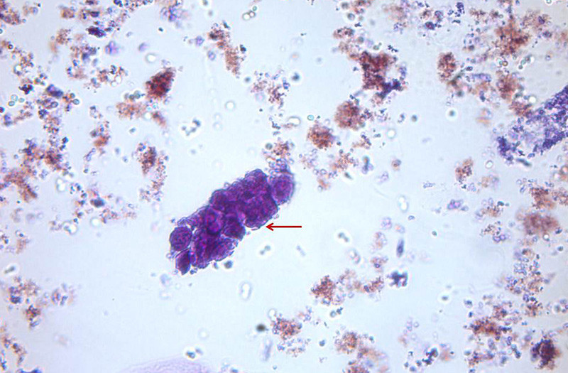 Figure 4  Urine sediment enlarged 40 times shows a cellular cast. These casts are formed by cells (in this case tubular&hellip;