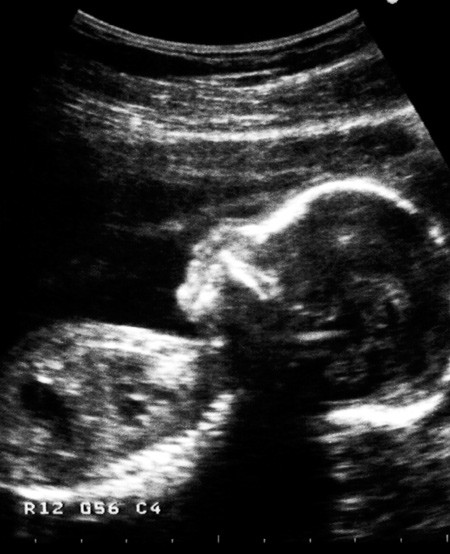 Illustrasjonsfoto: Elisabeth Ed&eacute;n/Bildhuset/TT