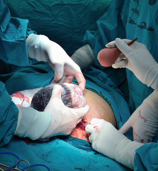 Keisersnitt er et av de hyppigst utf&oslash;rte st&oslash;rre operative inngrep her i landet. Illustrasjonsfoto Colourbox