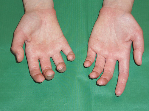 Figure 1  Marked atrophy of the small hand muscles, palmar aspect