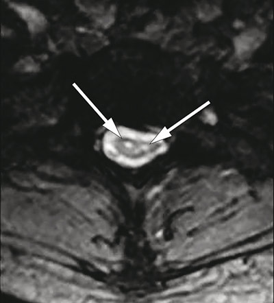Figure 4  Axial T2-weighted MRI of cervical medulla with symmetrical hyperintense lesions localised to the site of the&hellip;