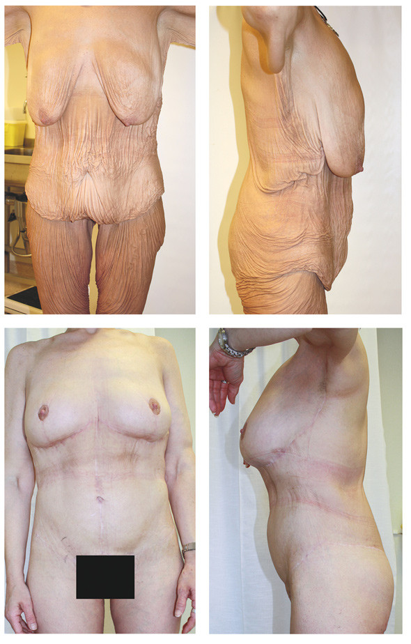 Figure 1  Woman in her thirties who lost 100 kg through dieting and exercise. The top two images show the patient before&hellip;