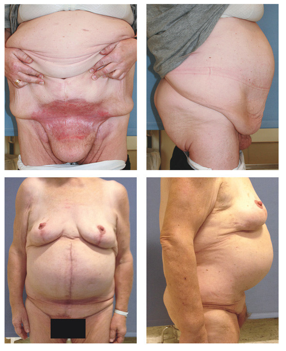 Figure 3  Woman in her fifties who had previously been refused treatment due to a high body mass index. The top two images&hellip;