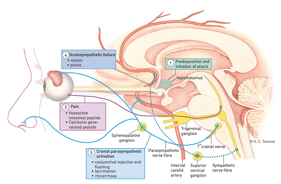 Figure 2  Postulated pathophysiological mechanism. The cause of cluster headache is unknown, and the mechanisms that&hellip;
