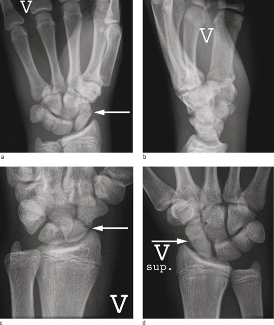 Figure 2  Standard X-ray projections on suspicion of scaphoid fracture, arrow where the fracture is visible. a) Frontal&hellip;