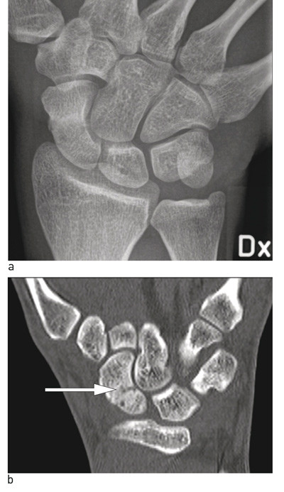 Figure 3  Acute scaphoid fracture, not visible on standard X-ray images. a) Frontal projection, overview picture (difficult&hellip;