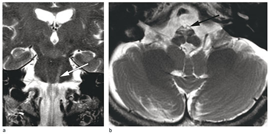 Figure 1  MRI of the patient&rsquo;s brain at 70 years of age. T2-weighted images. Abnormalities are asymmetrical and most&hellip;
