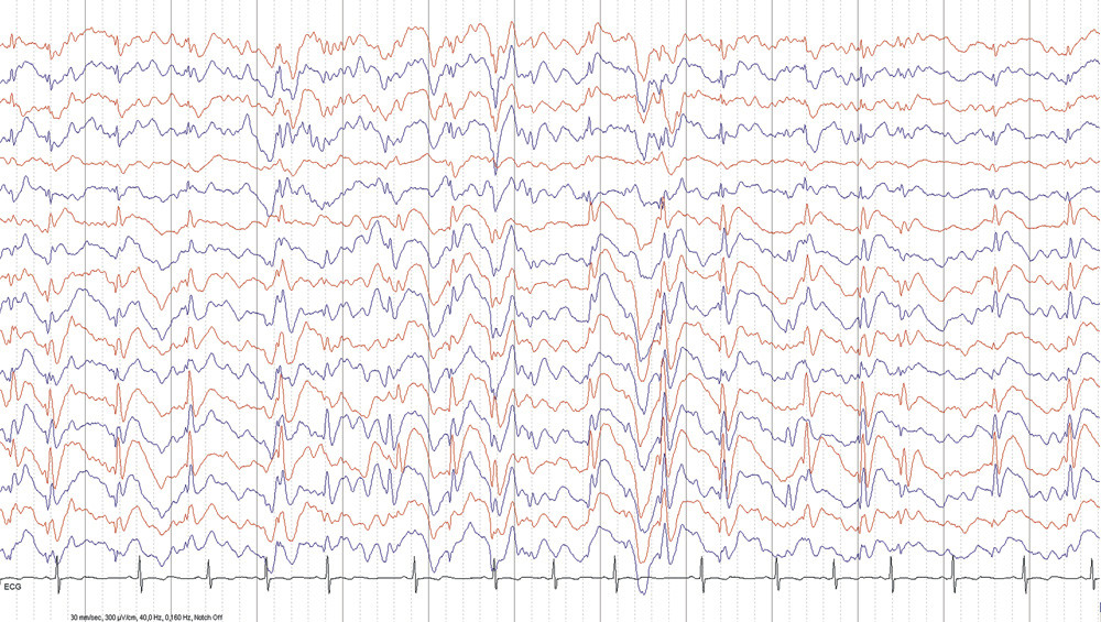 Figure 1  EEG recorded during non-REM sleep. There is an intense increase in epileptic activity, with left hemispheric&hellip;
