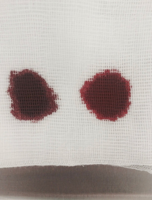 Figure 2  Brown blood. Patient&rsquo;s arterial blood on the left. Treating doctor&rsquo;s arterial blood on the right