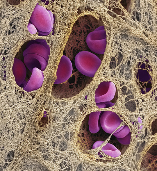 Trombe i koronararterie. Illustrasjonsfoto: Science Photo Library