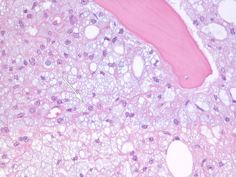 Figure 2  Light micrograph of bone marrow biopsy stained with haematoxylin and eosin (HE). The image is dominated by tightly&hellip;