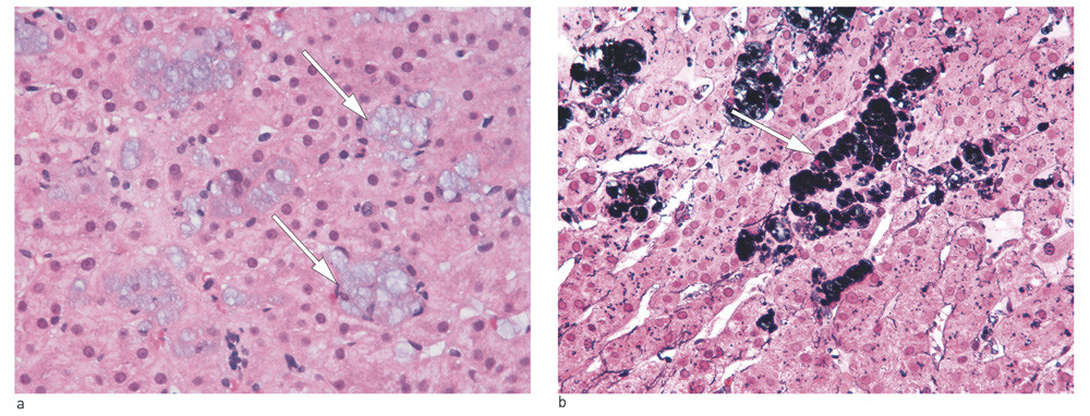 Figure 3  Light micrograph of hepatic tissue, showing accumulation of polyvinylpyrrolidone (PVP) or povidone-containing&hellip;