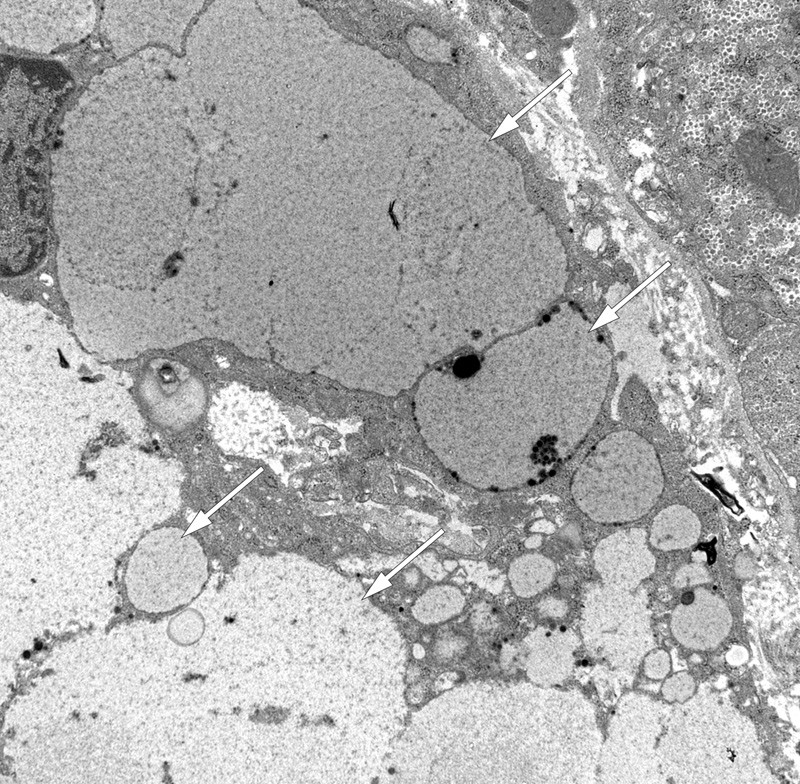 Figure 4  Transmission electron micrograph of hepatic tissue. Intracellular accumulation of polyvinylpyrrolidone (PVP) or&hellip;