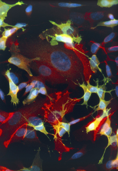 Nevroblastomceller. Foto: Science Photo Library