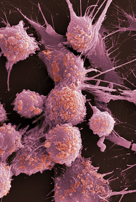 Kreftceller i prostata fremstilt ved hjelp av farget elektronmikrografisk skanning (SEM). Illustrasjon: Science Photo Library