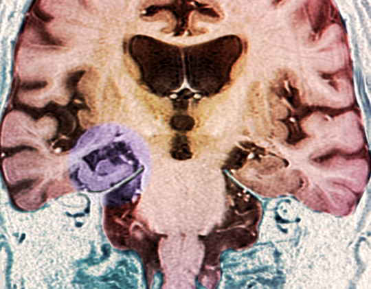 Farget MR-skann av koronal seksjon av hjerne og hjernestamme (nederst til venstre) hos en pasient med Alzheimers sykdom&hellip;