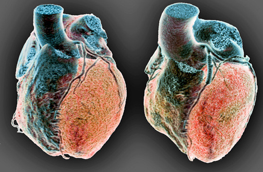 Perkutan koronar intervensjon. Foto: Science Photo Library