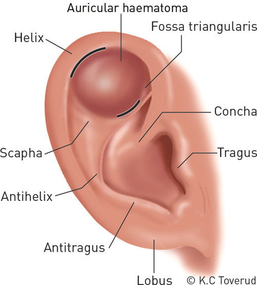 Figure 3  Illustration of the surface anatomy of the ear and the typical location of an auricular haematoma (in the cranial&hellip;