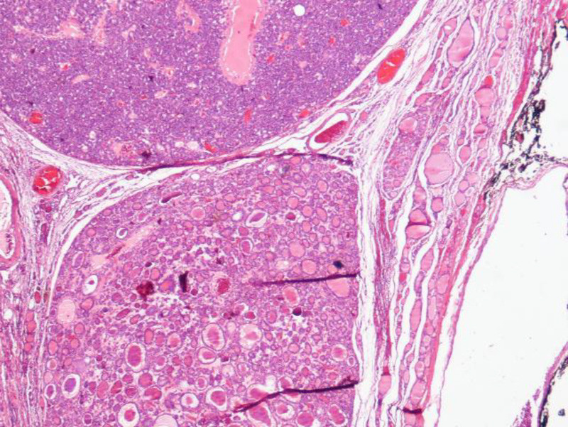 Figure 2  Image (microscopic) of left thyroid lobe with two tightly packed follicular adenomas