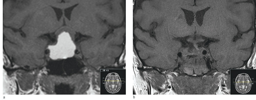 Figure 1  Coronary T1-weighted MRI images without contrast. a) Large opacity in sella turcica that extends up in the&hellip;