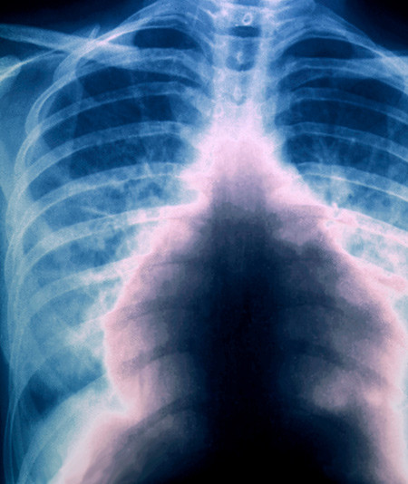 R&oslash;ntgen thorax viser massiv lungeembolisme. Foto: Science Photo Library