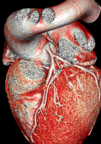 Et friskt hjerte fremstilt i farger ved hjelp av computertomografi. Foto: Science Photo Library
