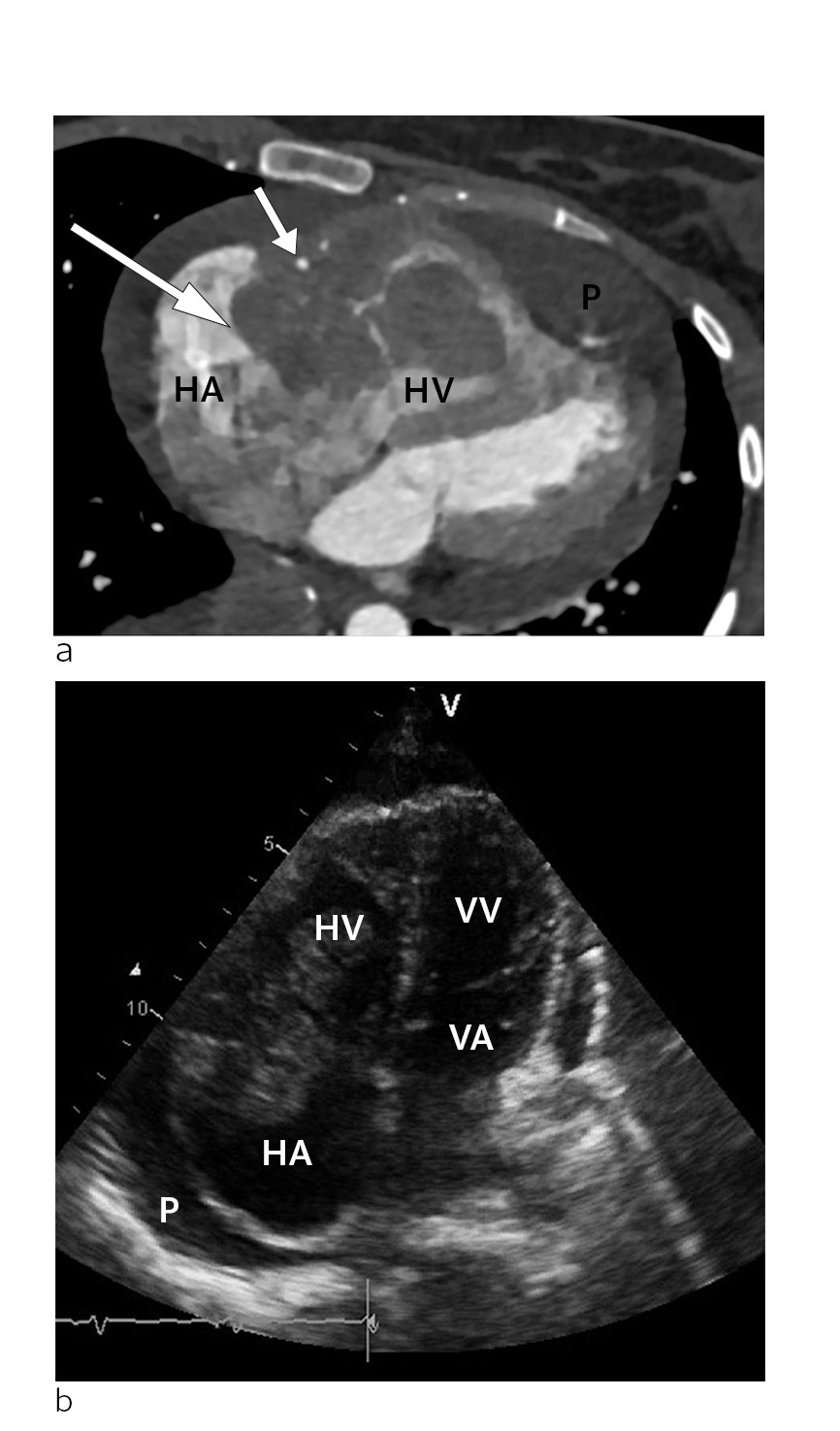 Figure 1 a) CT scan of the heart in the transverse plane at the time of diagnosis. Tumour (large arrow) in the right&hellip;