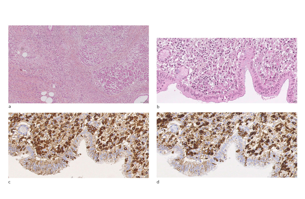 Figure 1 Histology specimens from patient with IgG4-related disease with pancreas affection. a) Section of pancreas&hellip;