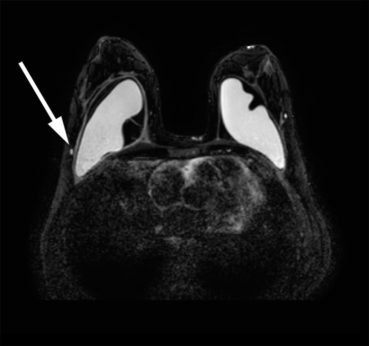 Figure 3 Breast MRI, silicone only sequence. Suspected small quantities of silicone in axillary lymph nodes