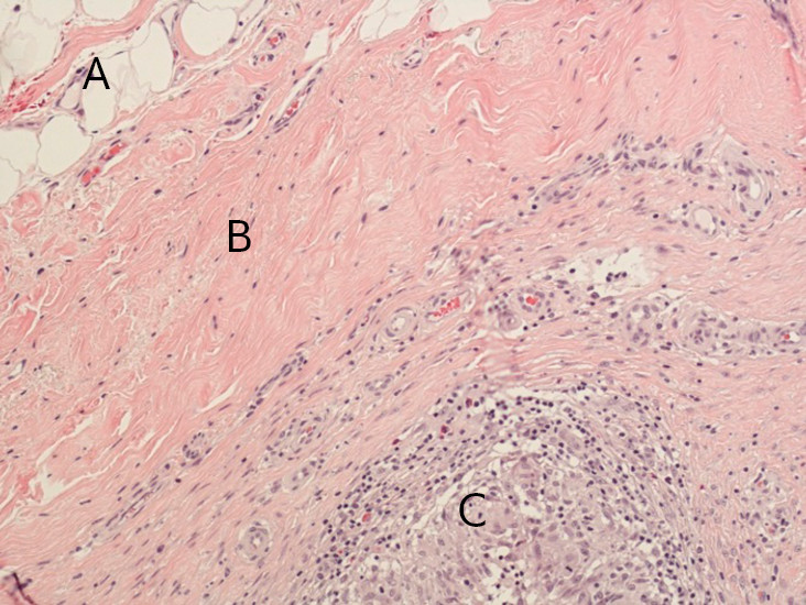 Figure 4 Section through implant capsule, right side: fatty tissue (A), connective tissue (B), granulomas (C). Microscopy&hellip;