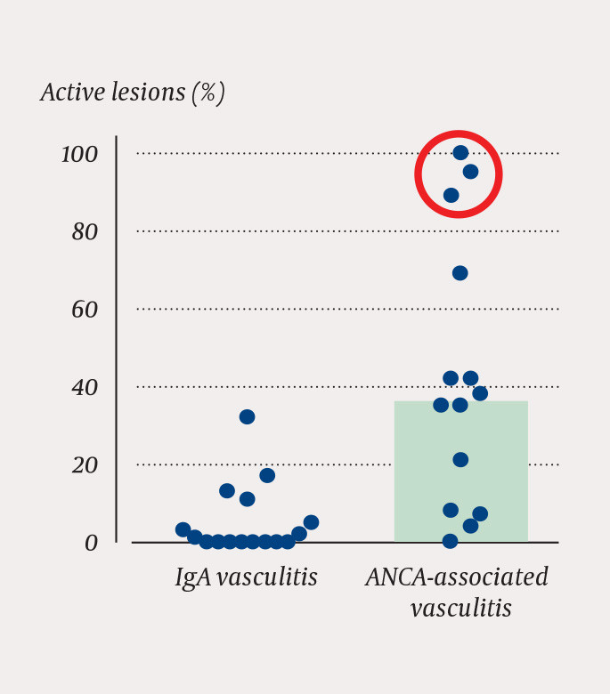 Figure 2 Percentage of glomeruli with active lesions (crescents/necroses). Each point represents a biopsy from a patient,&hellip;