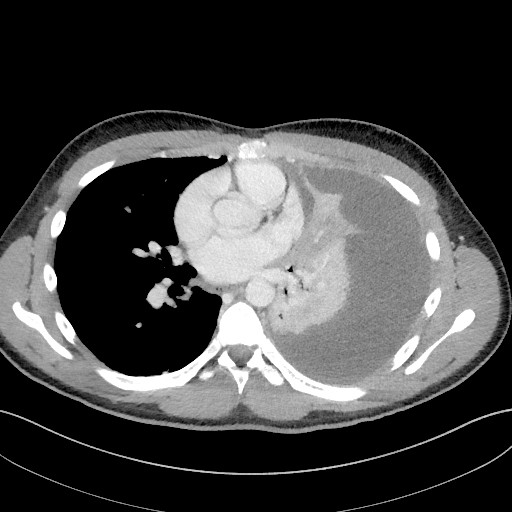 Figure 1 Axial CT images of the chest obtained one week after hospitalisation revealed that almost the entire left thoracic&hellip;