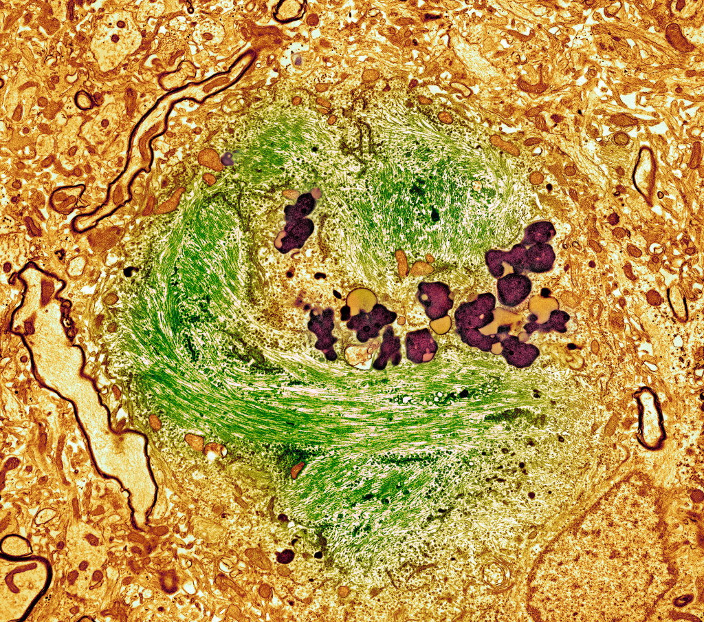 Farget transmisjonselektronmikroskopisk bilde av en nevofibrill&aelig;r floke i en nervecelle fra hjernen til en pasient med&hellip;