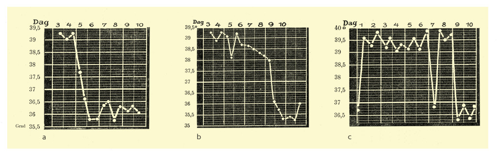 Figure 2 Examples of three forms of crisis in pneumonia (19). a) crisis with a drop in temperature on the fifth day; b) if&hellip;