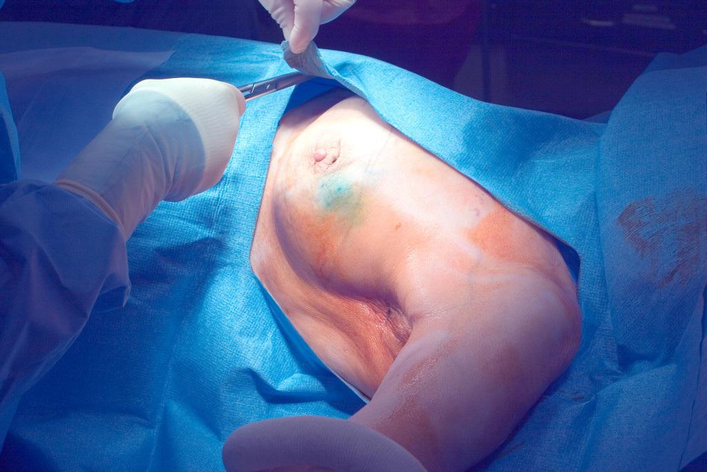 Forberedelse til vaktpostlymfeknutebiopsi og modifisert radikal mastektomi. Foto: Science Photo Library