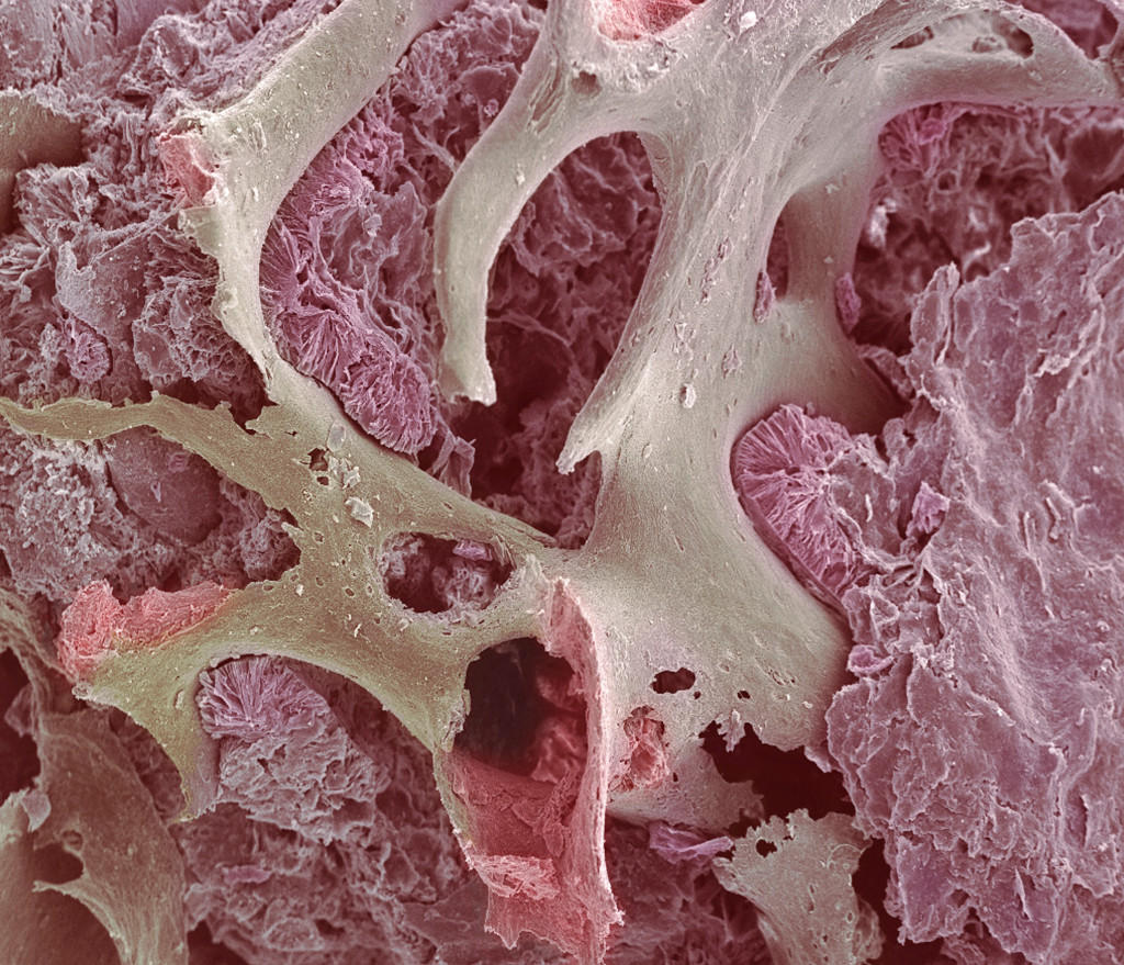 Osteoporotisk benvev. Illustrasjonsfoto: Science Photo Library/NTB scanpix