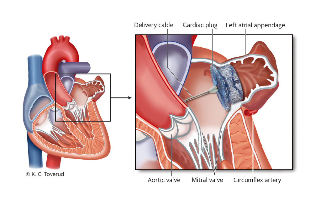 Figure 1 On the left, a four-chamber view of the heart. The cut-out on the right shows the left atrium with the cardiac plug&hellip;
