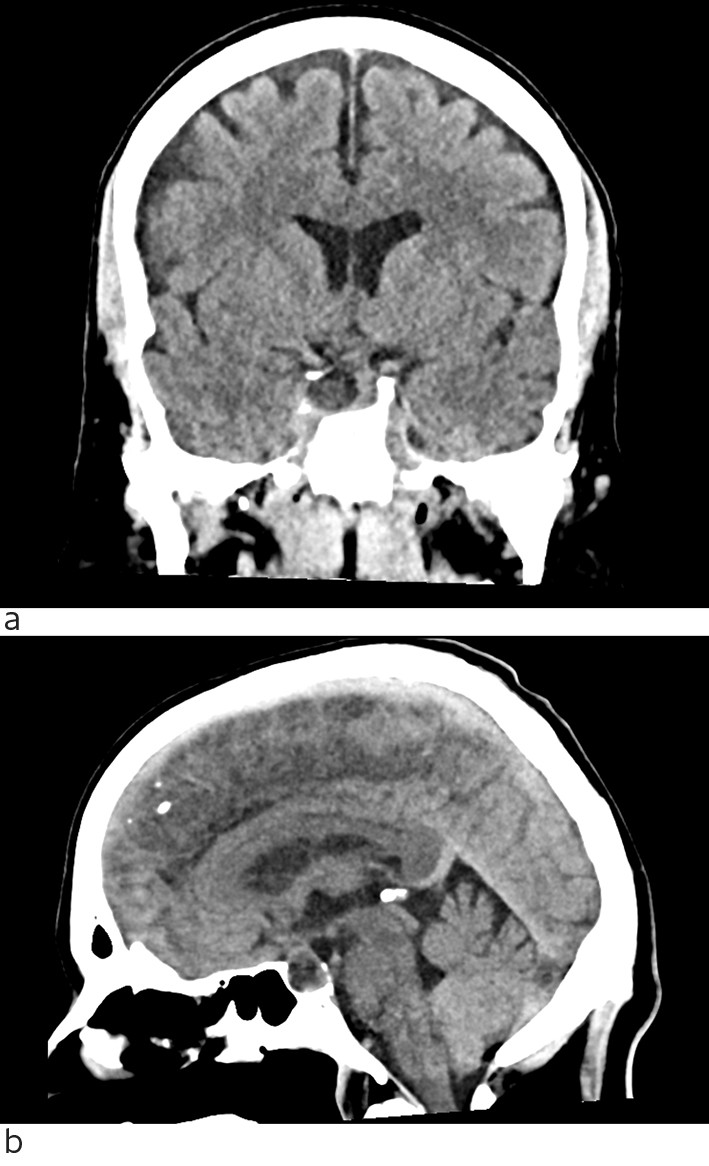 Figure 2 Head CT without intravenous contrast medium. a) coronal section, b) sagittal section. Expansive lesion in sella&hellip;